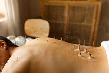 Moxibustion used with acupuncture 